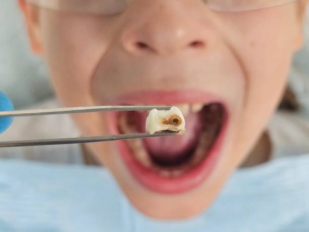 Best Emergency Dental Care for Broken or Chipped Teeth in Glendora, CA